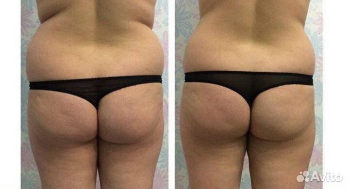 Антицеллюлитный массаж, скульптура тела и лица