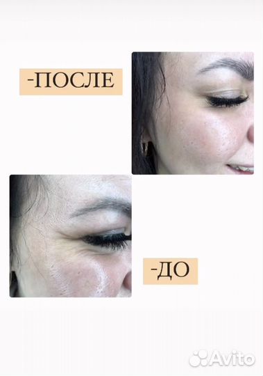 Ботокс для лица