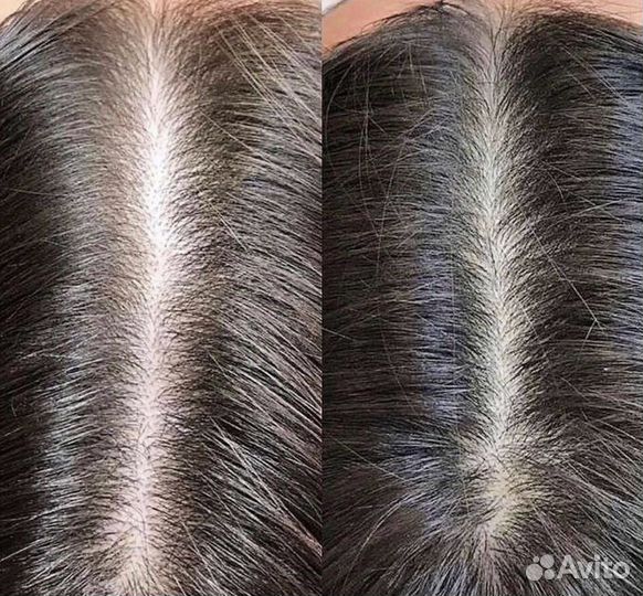 Мезотерапия головы