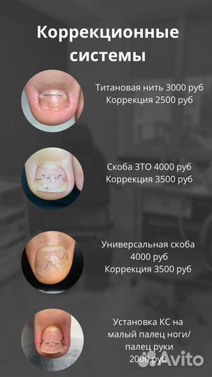 Подолог педикюр вросший