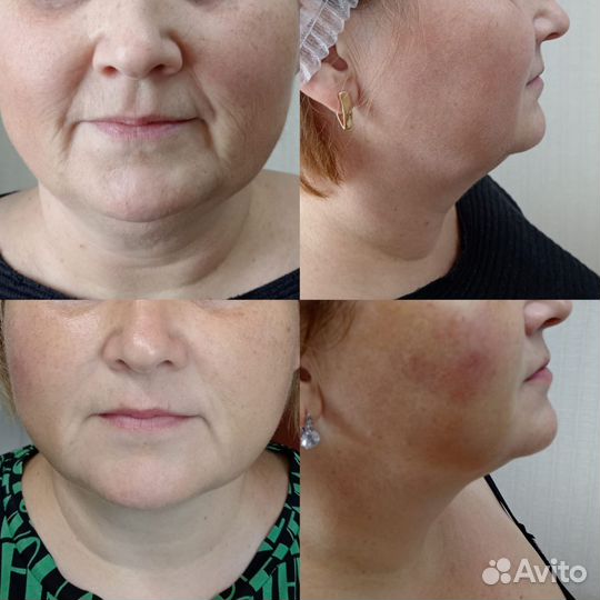 Элос - омоложение, эпиляция, чистка лица