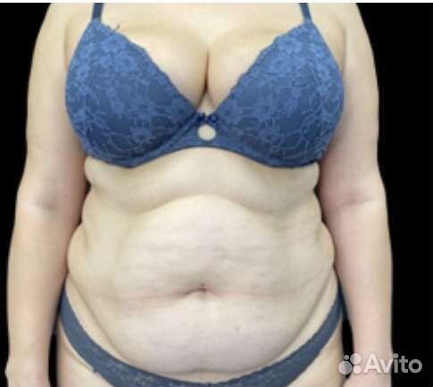 Аппаратное похудение