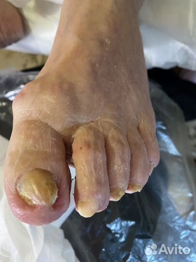 Педикюр подолог