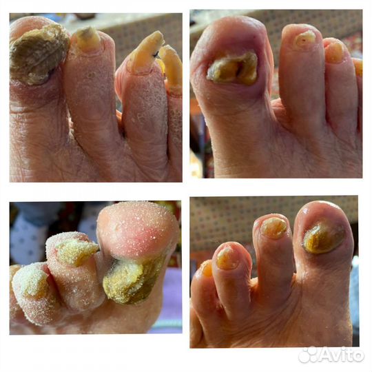Бородавки.Мозоли.Вросшие ногти.Педикюр.Подолог