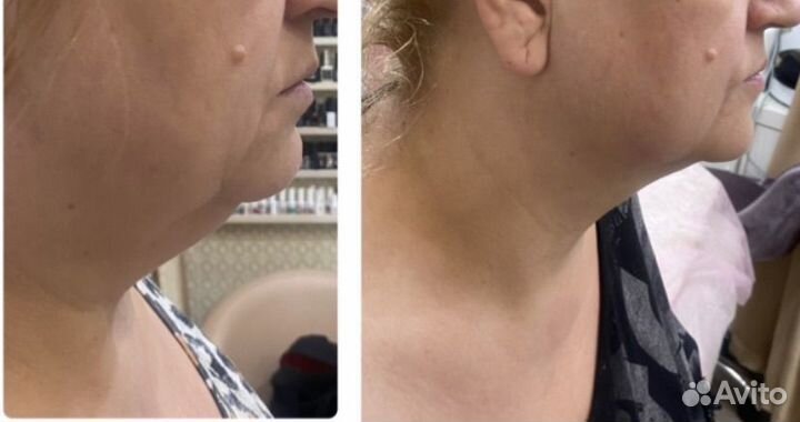 Exilis Ultra 360 RF лифтинг тела похудение