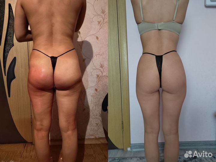 Коррекция Фигуры Массаж RF лифтинг