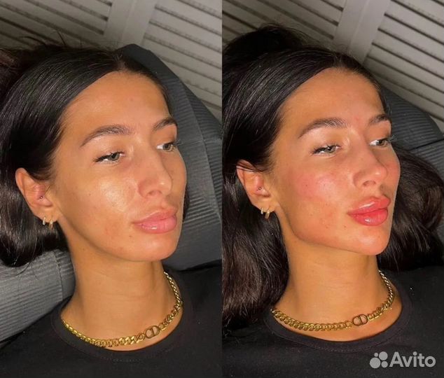 Лицо под ключ Full Face гармонизация обучение