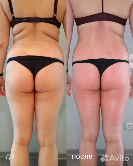 Антицеллюлит. вакуумный массаж тела,лица,кавитация