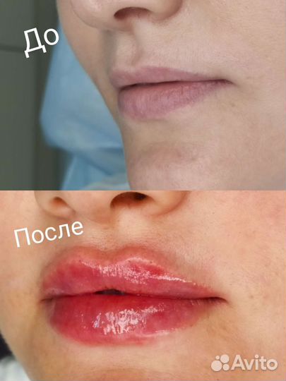 Косметолог плазмолифтинг,ботокс,увеличение губ