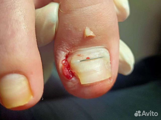 Лечебный педикюр