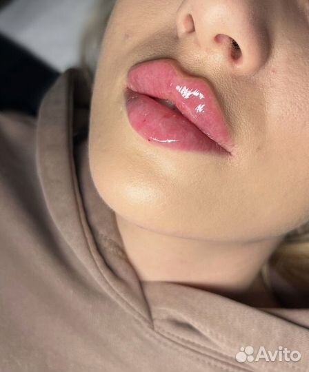 Увеличение Губ Ялта