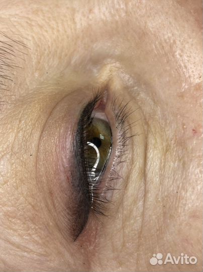 Татуаж, лазерное удаление татуажа и тату