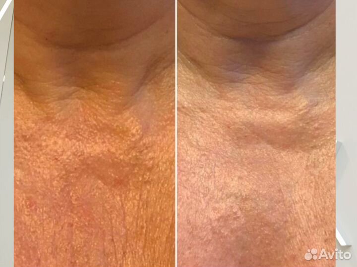 РФ - лифтинг / RF лифтинг лица и тела