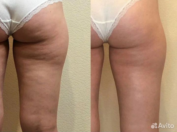 Массаж/Lpg массаж/антицеллюлитный массаж