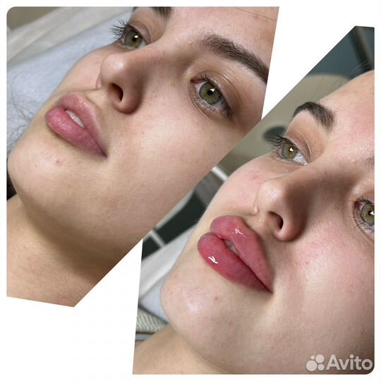 Косметолог /увеличение губ/ ботокс/мезо /плазма