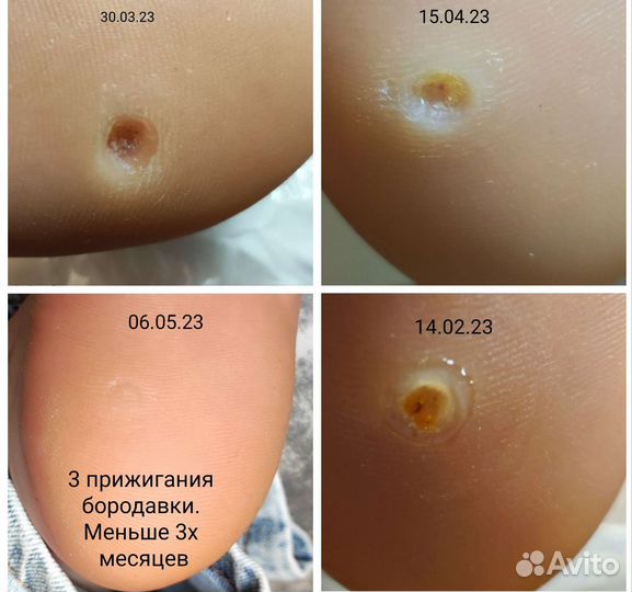 Подолог, педикюр, вросший ноготь, бородавка