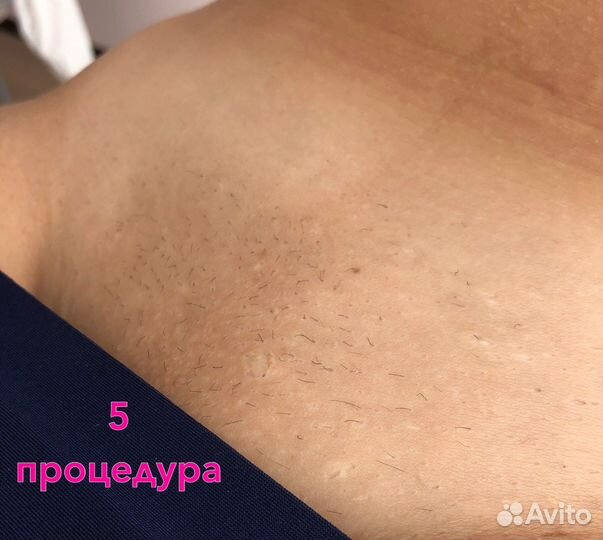 Лазерная эпиляция