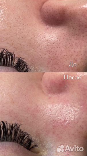 Чистка лица