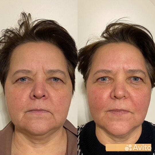 Скульптурный глубокотканный массаж лица