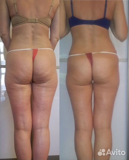 Антицеллюлитный массаж