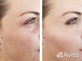 Карбоновый пилинг лица