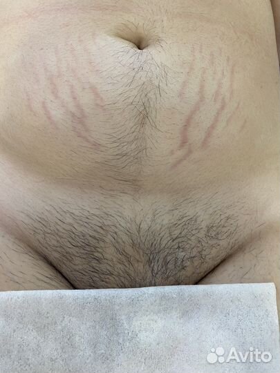 SPA-Шугаринг