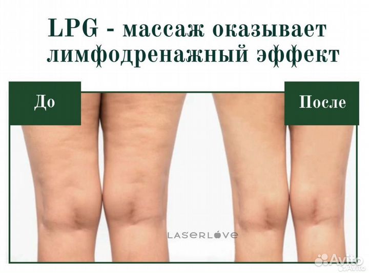 Аппаратный LPG массаж