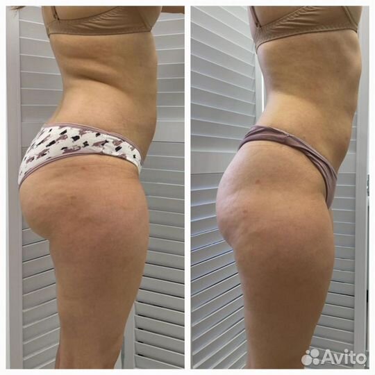 Аппаратная коррекция фигуры