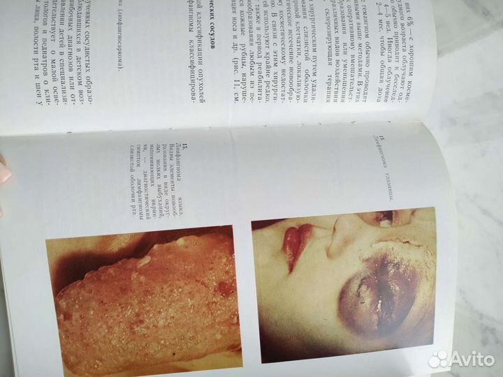 Новообразования мягких тканей и костей лица у дете