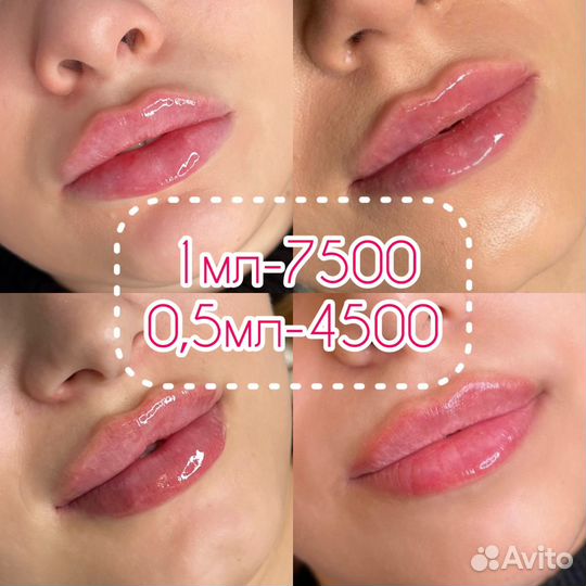 Увеличение губ