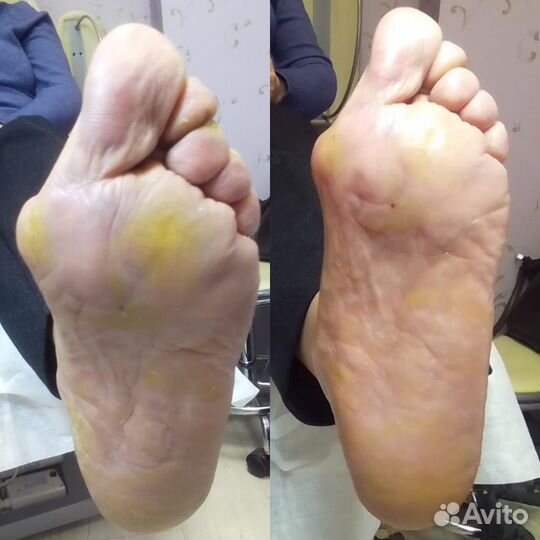 Медицинский педикюр, подолог