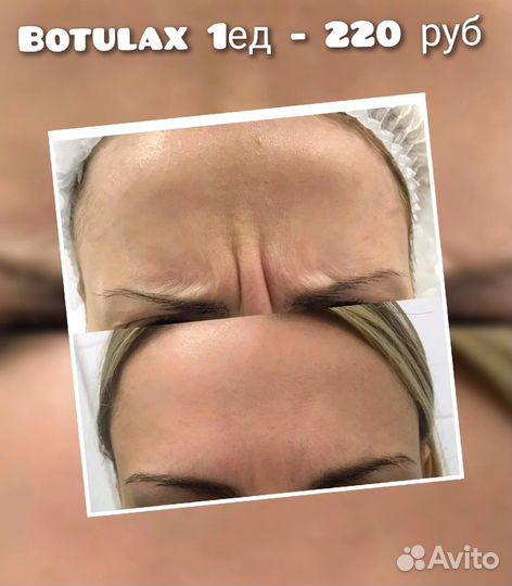Ботокс для лица