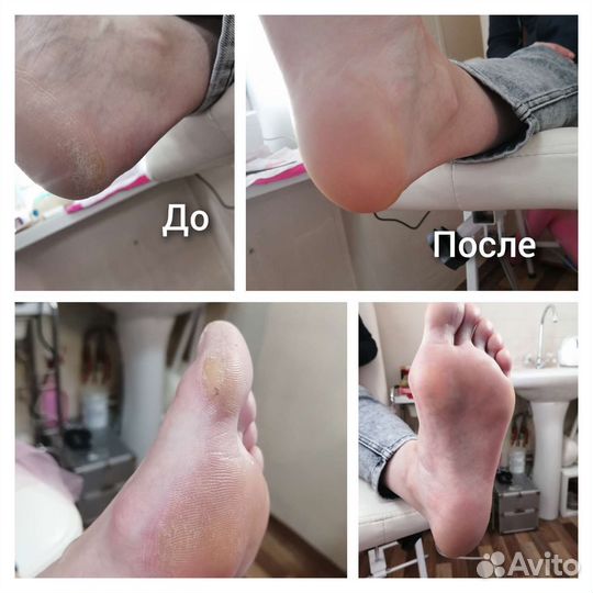 Препаратный педикюр