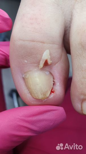 Титановая нить, Вросший ноготь. Подолог