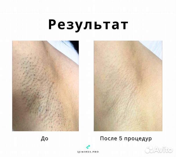 Диодный лазер люминес Макс.Ван 1200 Вт