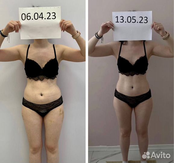 Аппаратная коррекция фигуры, криолиполиз,кавитация