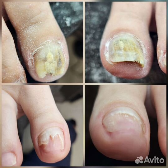 Лечебный педикюр подолог