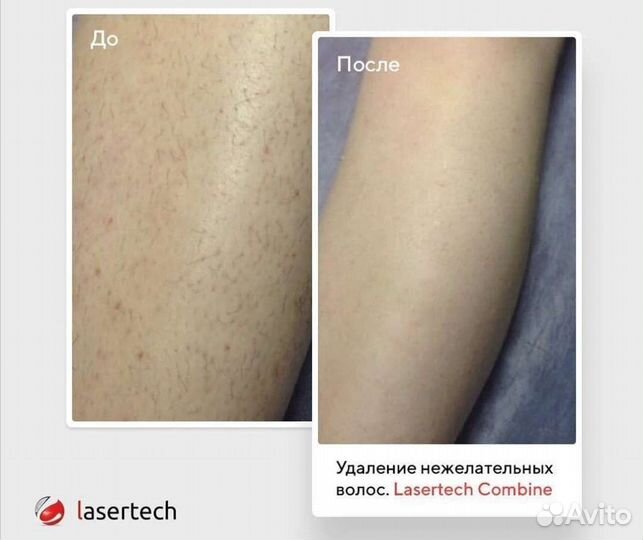 Элос-эпиляция: глубокое бикини