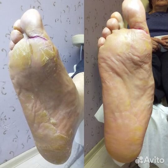 Медицинский педикюр, подолог