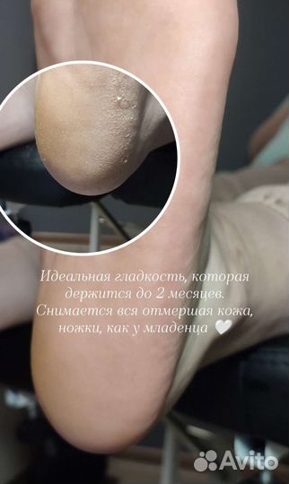 Кислотный педикюр (трещины, натоптыши)