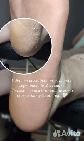 Кислотный педикюр (трещины, натоптыши)