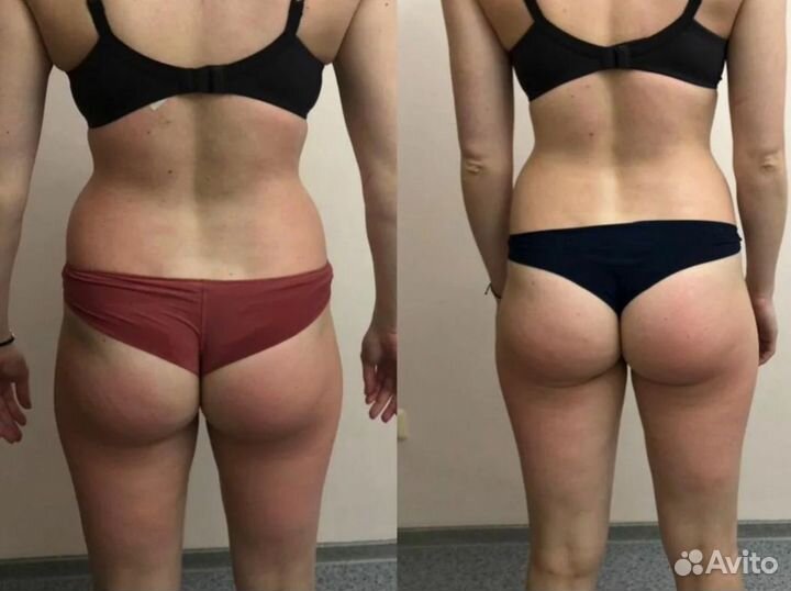 Массаж/Lpg массаж/антицеллюлитный массаж