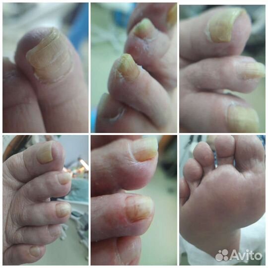 Педикюр медицинский (подолог)с выездом на дом