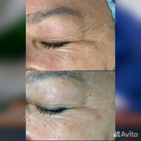 Холодная плазма. Аппаратная косметология. Акне