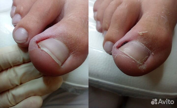 Лечебный (медицинский) педикюр подолог