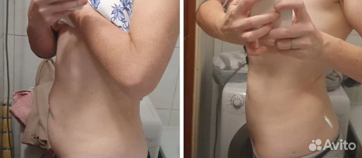 Плоский живот за 1 процедуру