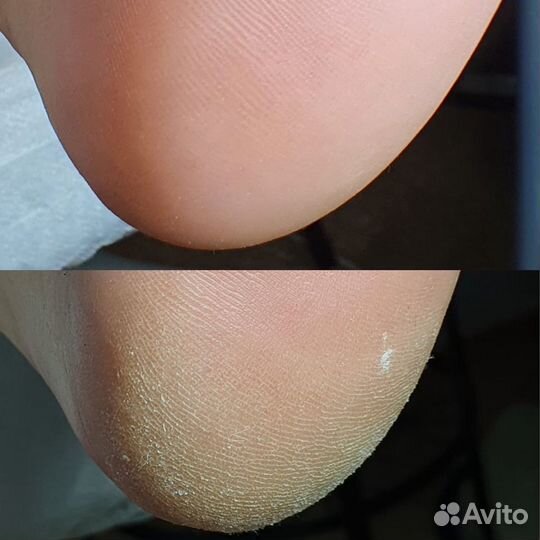 Аппаратный педикюр