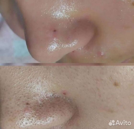 Косметолог чистка лица профессиональная