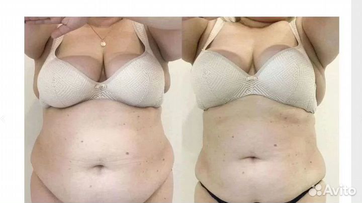 Криолиполиз в Самаре