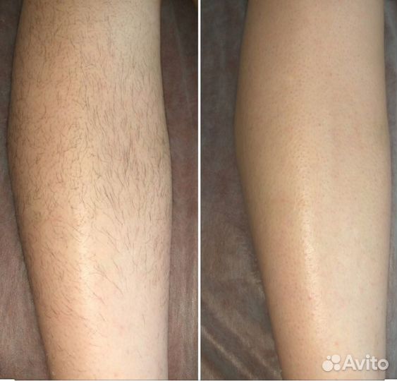 Шугаринг: подбородок